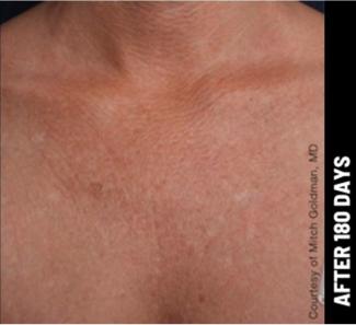 Ultherapy Before & After Patient #1556